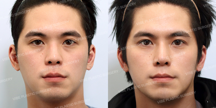 Before/After