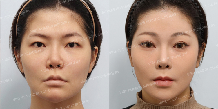 Before/After