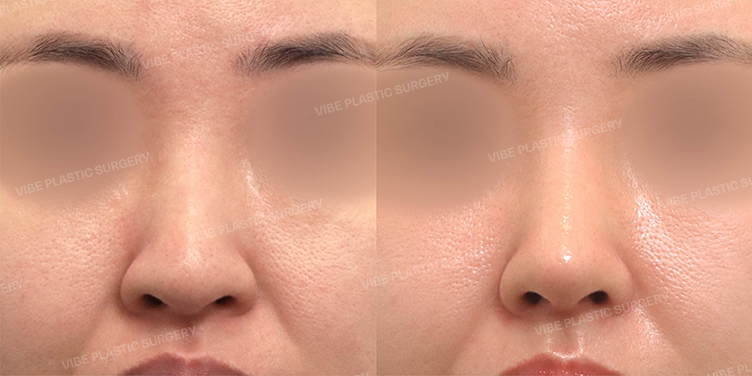 Before/After