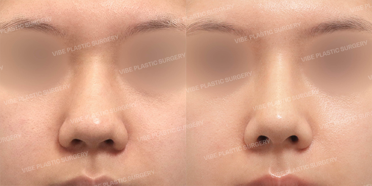 Before/After