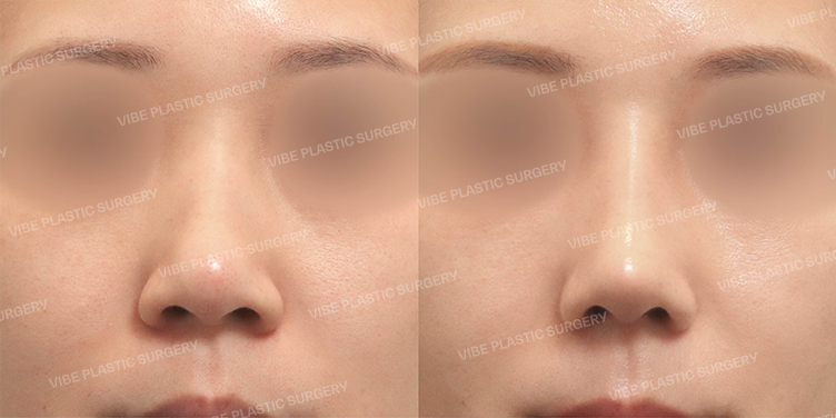 Before/After