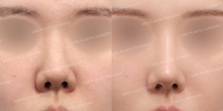 Before/After