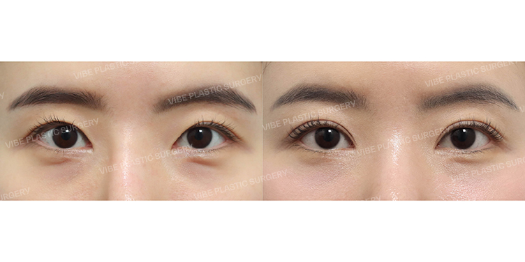 Before/After