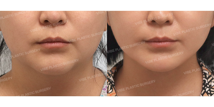 Before/After