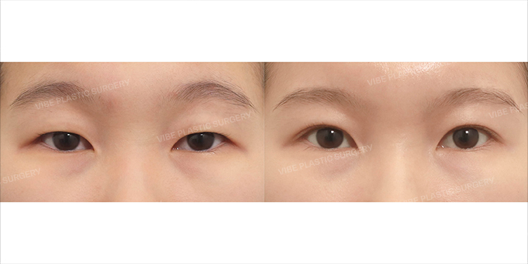 Before/After