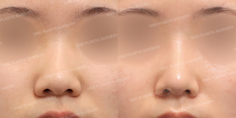 #Nasal Bridge #Nose Tip #Donor Rib #Septum