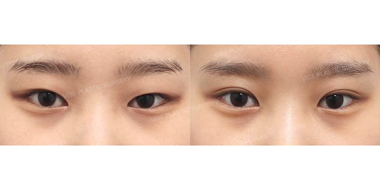 Before/After