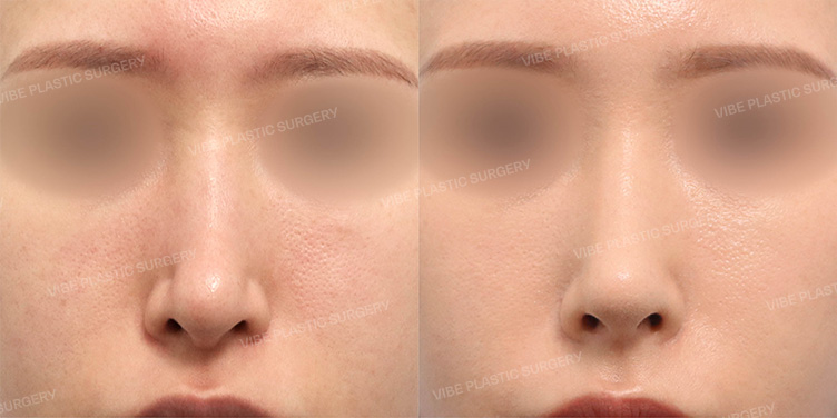 Before/After