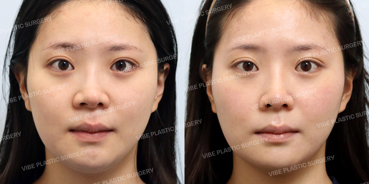 Before/After