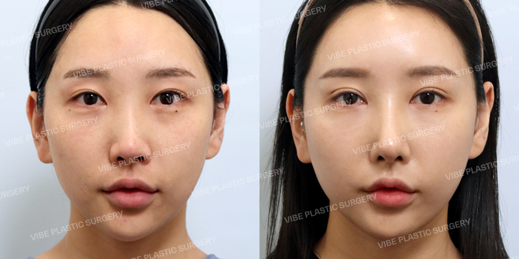 Before/After