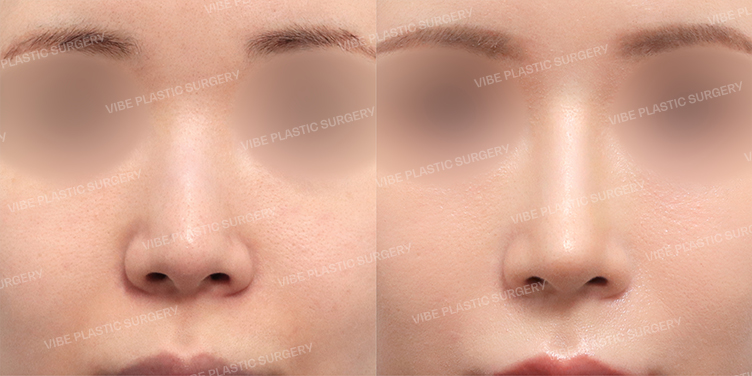 Before/After