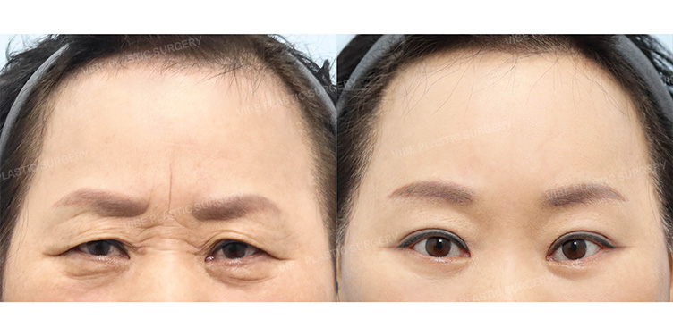 Before/After