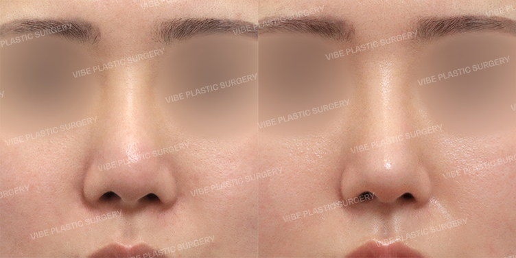 Before/After