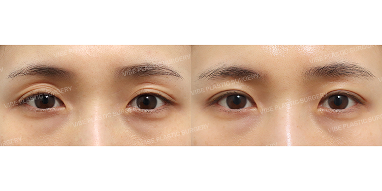 Before/After