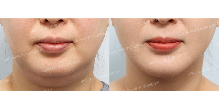Before/After