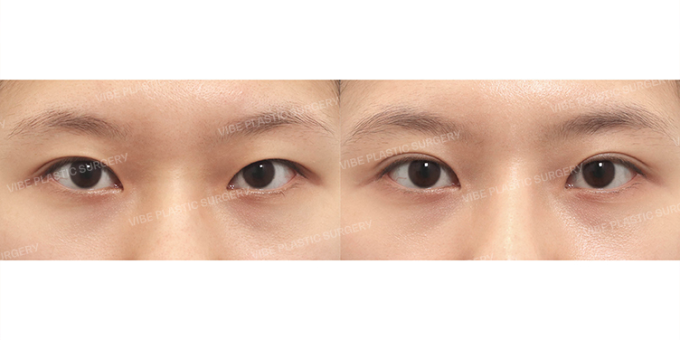 Before/After