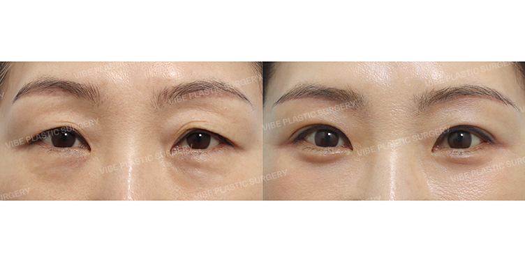 Before/After