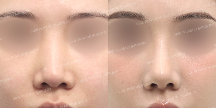 Before/After