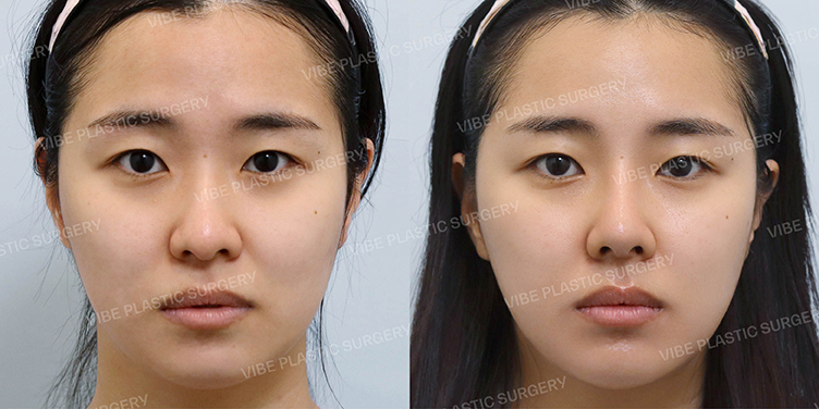Before/After