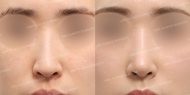 Before/After