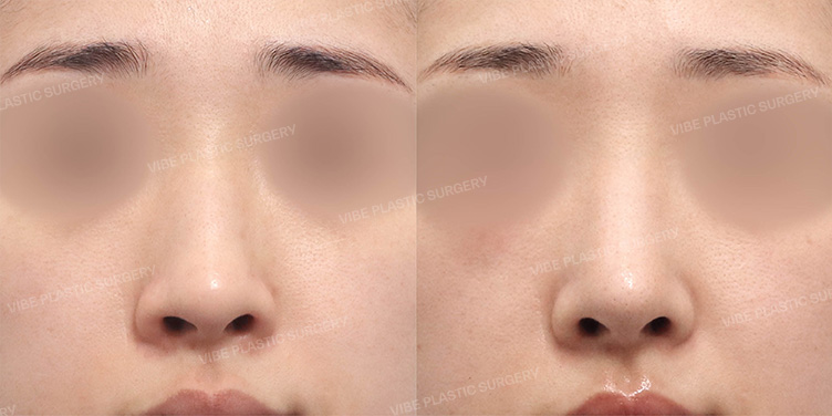 Before/After