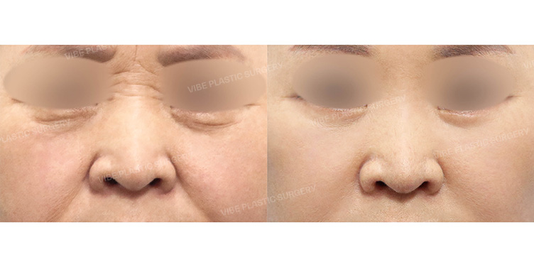 Before/After