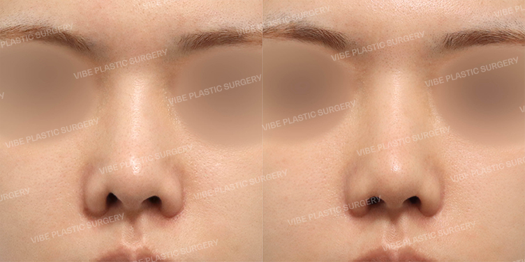 Before/After