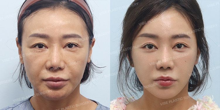 Before/After