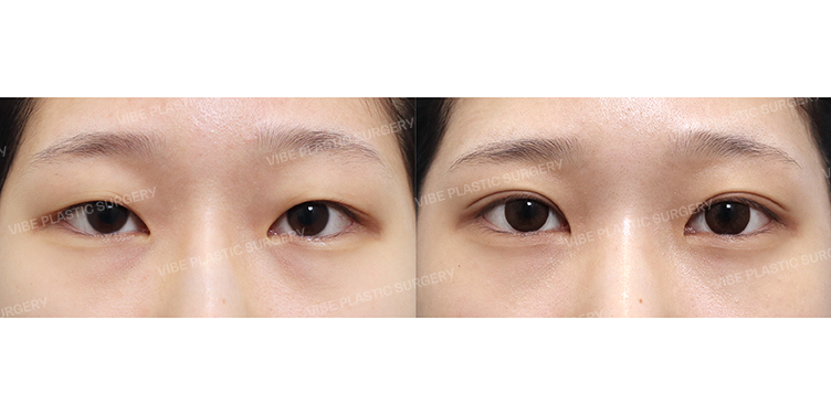 Before/After