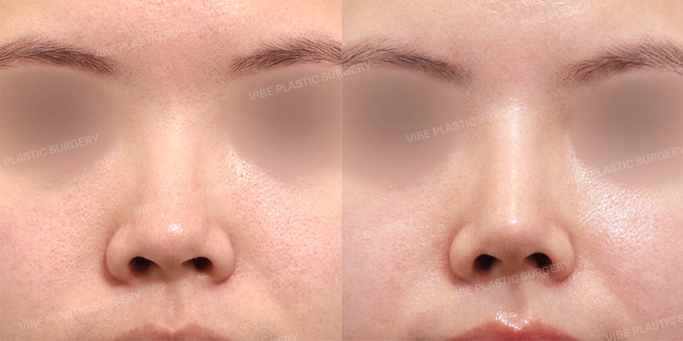 Before/After