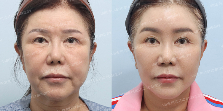 Before/After
