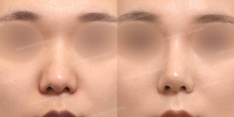 Before/After