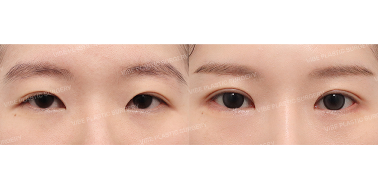 #Incisional Double Eyelid(Revision) #Lateral-lower Canthoplasty