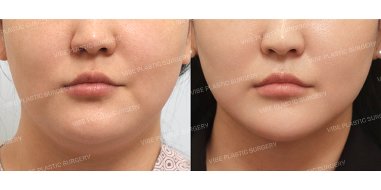 Before/After