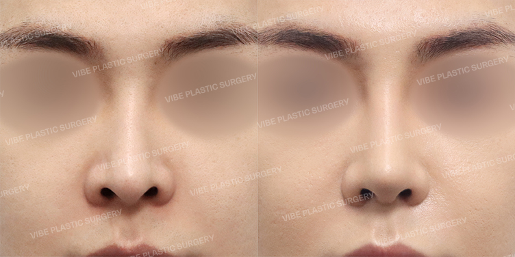Before/After
