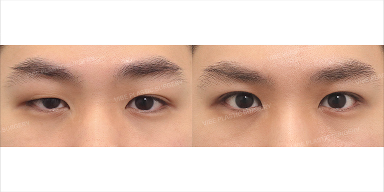 Before/After