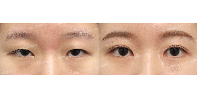 Before/After