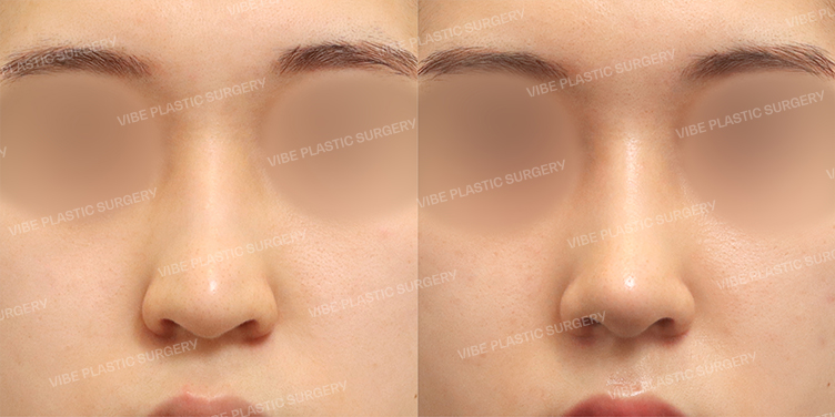 Before/After