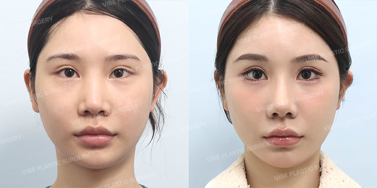 Before/After