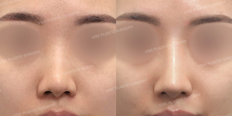 Before/After