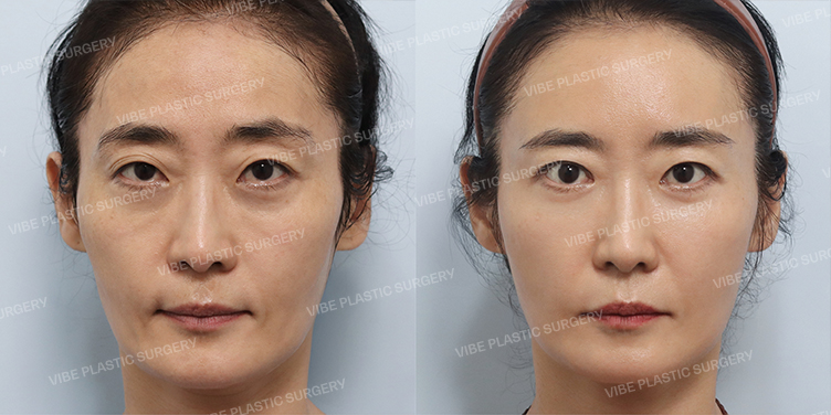 Before/After