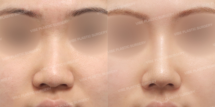 Before/After