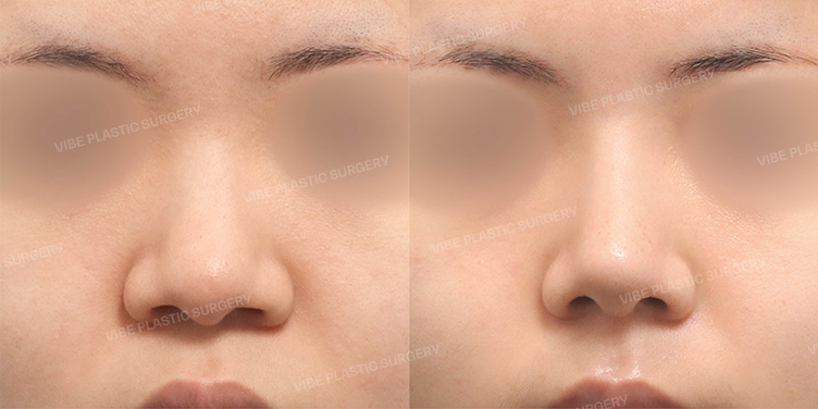Before/After