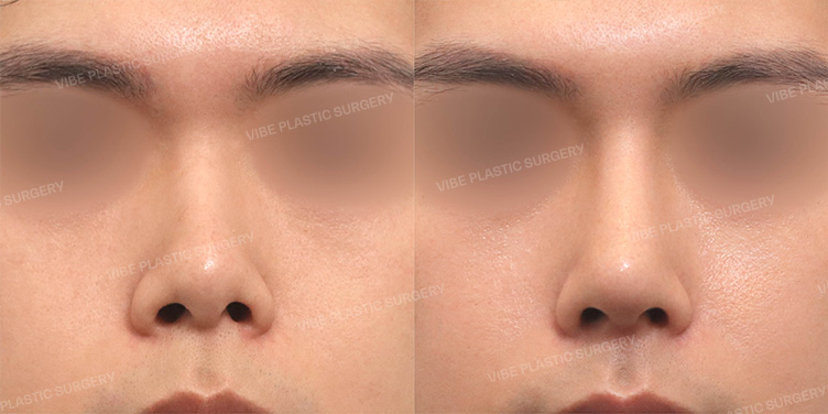 Before/After