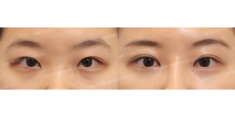Before/After