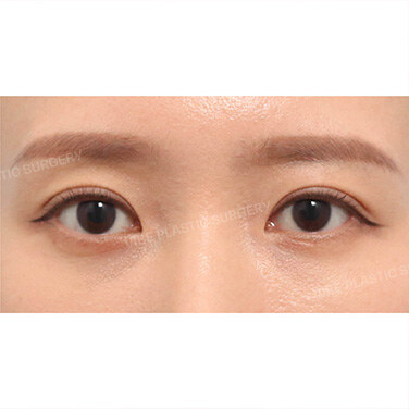 첫눈성형 After
