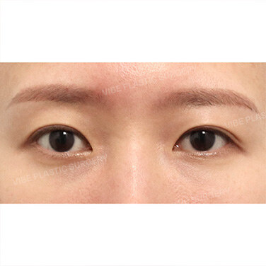 첫눈성형 Before