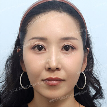 지방성형 After