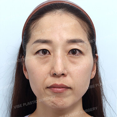 지방성형 Before