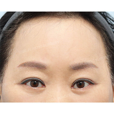 중년눈성형 After